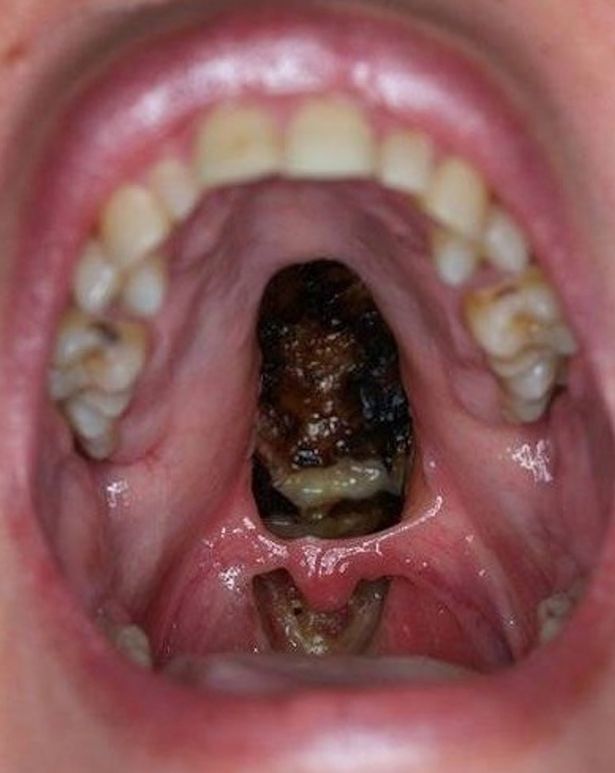 Palatal-perforation-due-to-Cocaine-Abuse
