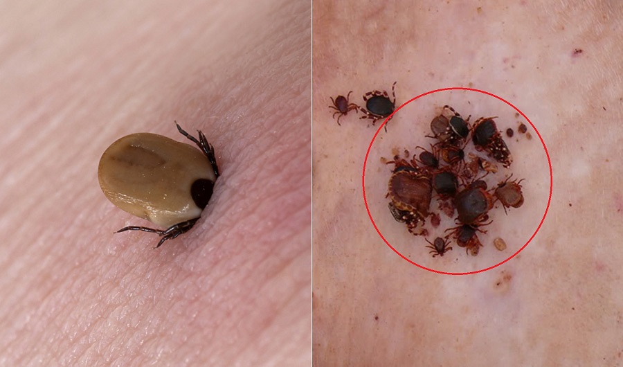 tick-bites