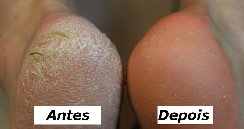 hidratante-para-os-pes