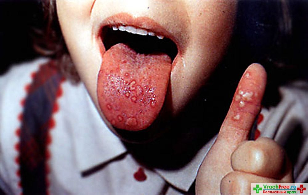 koksaki-i-echo-infektsiya-u-detej3