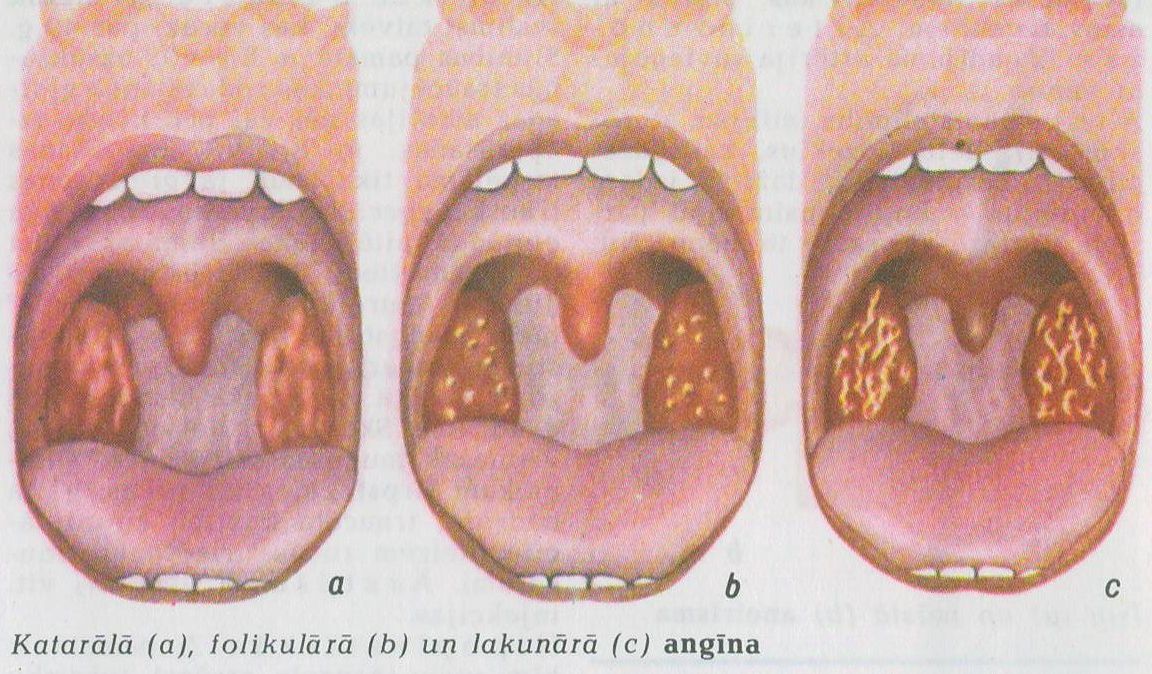 pme_angina